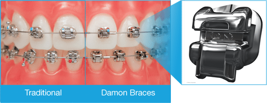 Side-by-side comparison of traditional twin brackets and Damon self-ligating brackets